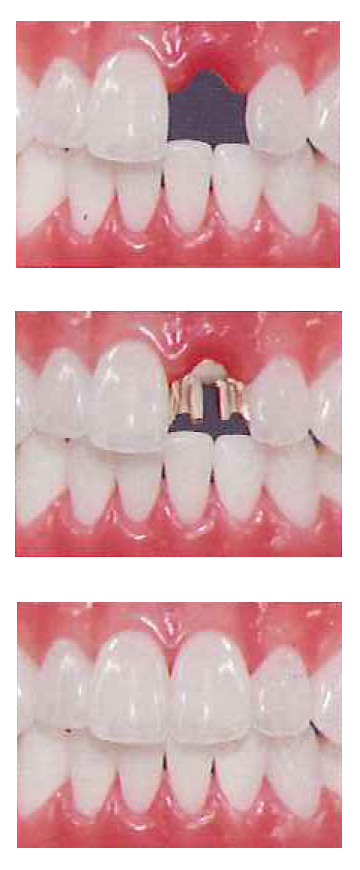 治療の流れ(前歯)
